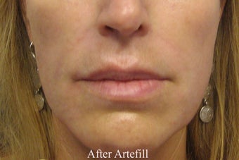 Artefill after 152203