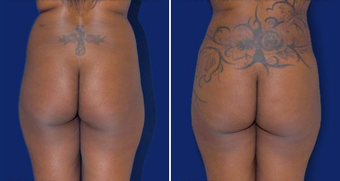 Brazilian Butt Lift before 494510