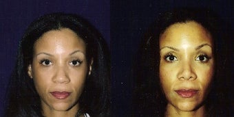 Rhinoplasty and Septoplasty after 241674