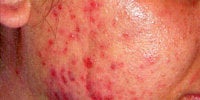 Acne Treatment with Smoothbeam before 271997