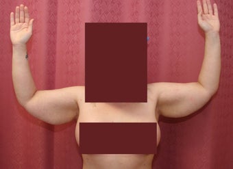 Brachioplasty or arm tuck before 583681