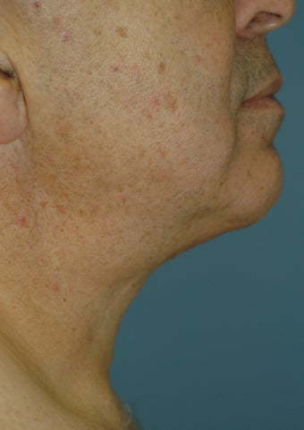 Neck Lift after 537398