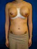 Revision Breast Surgery 356579