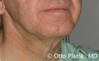 Cervicoplasty 567302
