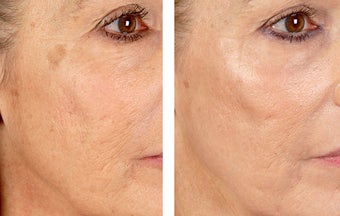 Active FX Fractional Laser Resurfacing before 254005