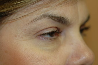 CO2 Laser resurfacing 341479