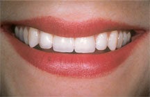 Dental Implant For Missing Front Tooth after 504342