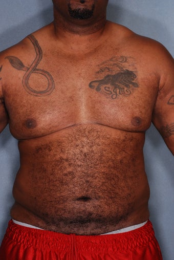 SmartLipo Breasts & Abs before 356667
