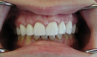 Gum lift (Crown Lengtheing), Root coverage with soft tissue Graft, after 565879