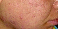 Acne Treatment with Smoothbeam after 271997