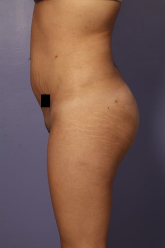 Buttock augmentation after 585019