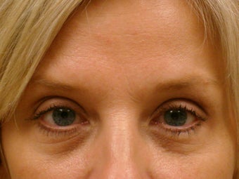 Botox Cosmetic after 375186