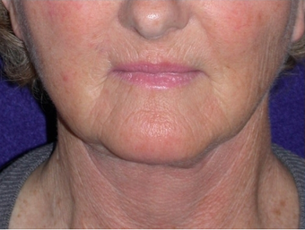 Necklift after 208439