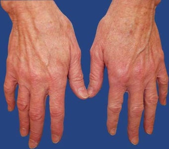 Dermal Filler for Hand Rejuvenation before 513513