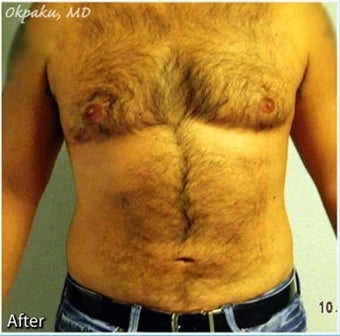 Male Liposuction of Abdomen and flanks after 277008
