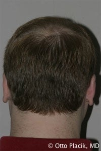 Otoplasty 567309