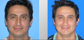 Rhinoplasty before 293535