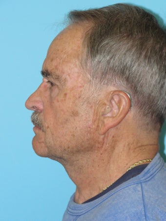 Necklift after 574633