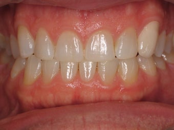 Tooth Whitening before 366619