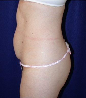 Tummy Tuck (abdominoplasty) 208465