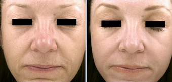Pro-Fractional before 333390
