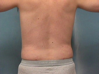 Liposuction after 140076