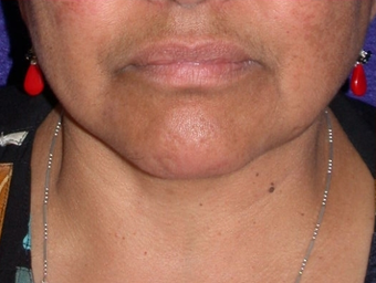 Necklift after 208453