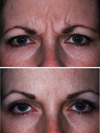 Botox Forehead Before and After before 6332