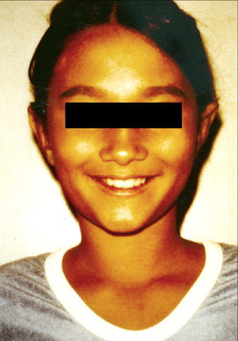 Otoplasty after 483144