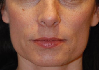 Mole removal after 199334