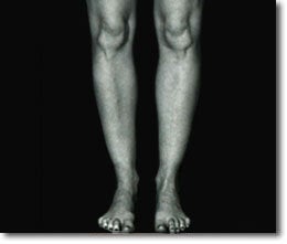 Calf Implant after 566015