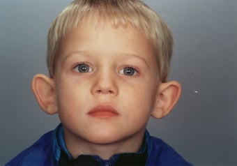 Otoplasty before 322019