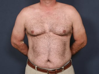 Liposuction before 640754