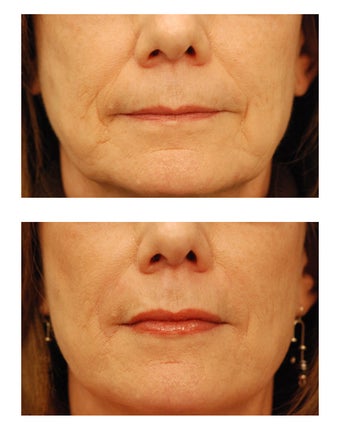 Restylane before 149887