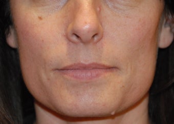 Mole removal before 199334