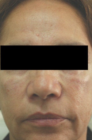 Cheek Shaping with Juvederm Los Angeles Before and After Photos after 204760