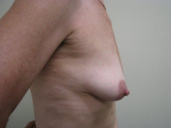 Breast Reconstruction Immediate 347580