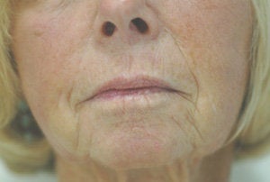 Juvederm for Smile Lines Long Beach, CA Before and After Pictures before 204767