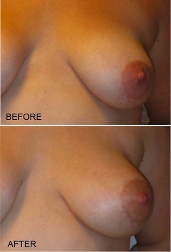 LSGAP "Love Handle" Flap Breast Reconstruction before 416806