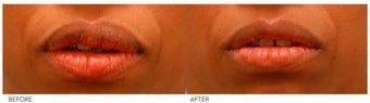 Lip Reduction/Lip Correction before 136736