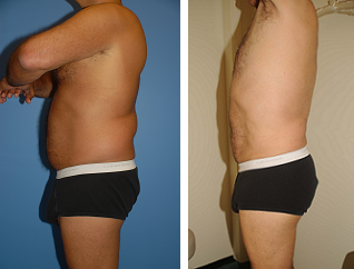 Male Liposuction before 289514