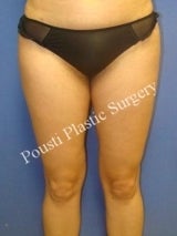 Liposuction after 633674