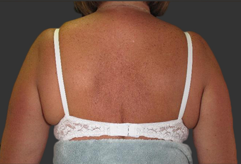 Exilis after 423762
