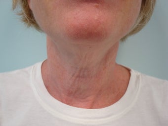 Thermage before 611065