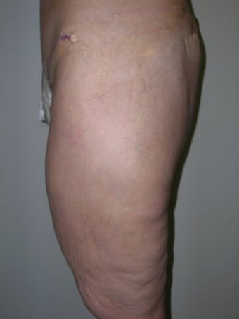 Thigh Lift after 259011