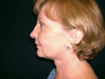 Necklift after 233743