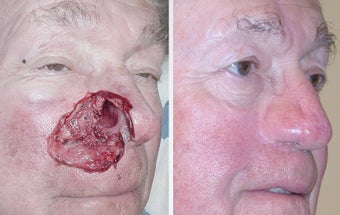 Facial Reconstruction after MOHS Surgery before 378710