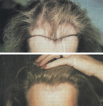 female hair transplant before 369169
