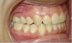 Invisalign Treatment after 359152