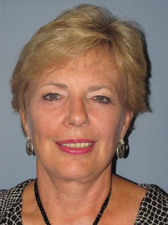 Neck Lift, Platysmaplasty after 634747
